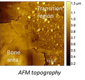 AFSEM image of bone sample with a partially dissolved implant obtained in force volume mode. (Figure 1) AFM Topography image of the bone area and transition region, where the implant is partially dissolved.